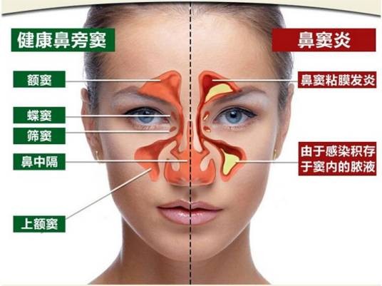 慢性过敏性鼻炎
