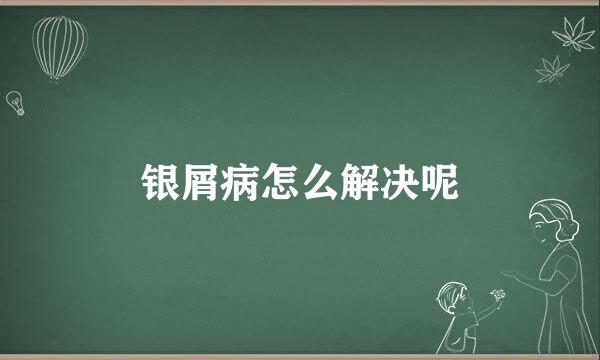 银屑病怎么解决呢
