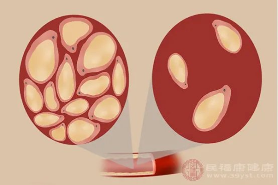 什么是甘油三酯
