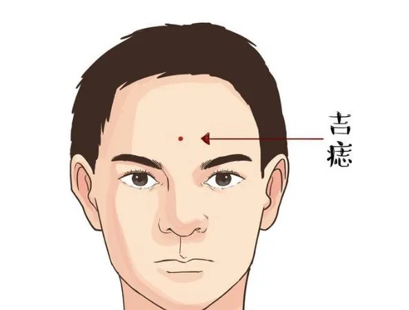 激光去痣费用