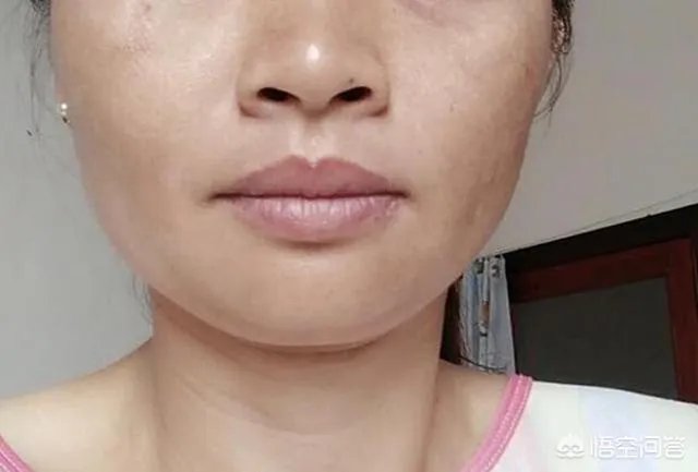有了黄褐斑,该如何淡化不反弹?