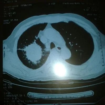 中医治疗肺癌