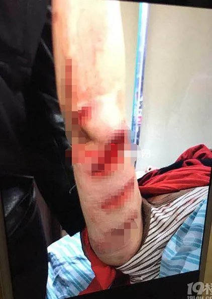 63岁大妈钱塘江游泳被渔船的螺旋桨打得皮开肉绽是怎么回事?