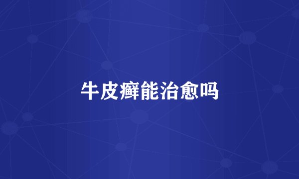 牛皮癣能治愈吗