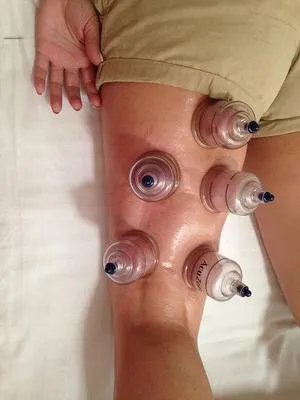 湿疹拔罐有用吗 拔罐的方法