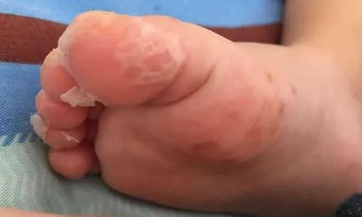 小儿手足口病最早期图片