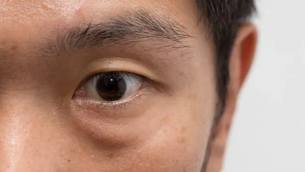 下眼袋怎么去除
