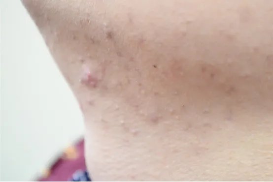下巴长痘痘是什么原因