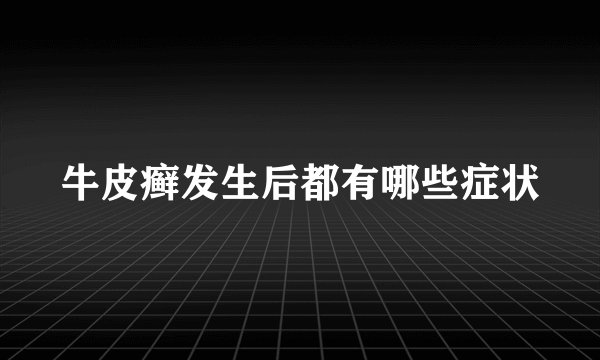 牛皮癣发生后都有哪些症状