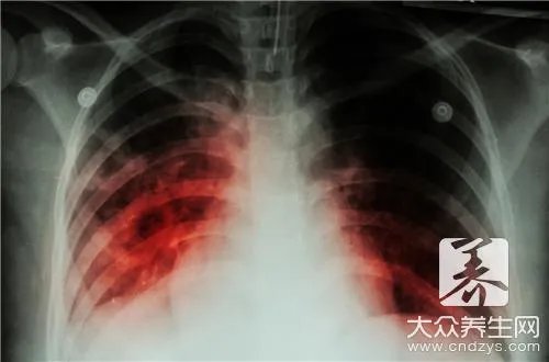 结核病防治知识内容是什么?
