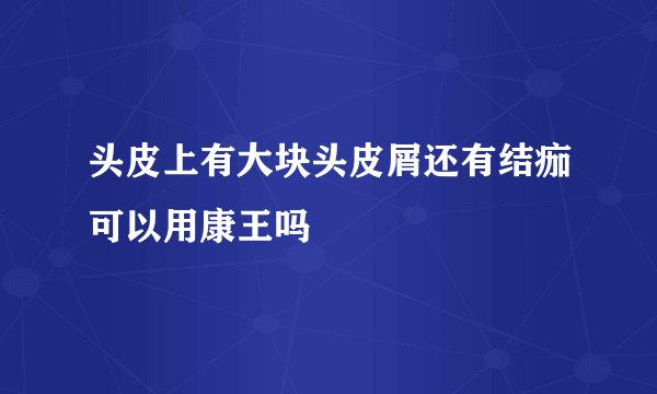 头皮上有大块头皮屑还有结痂可以用康王吗