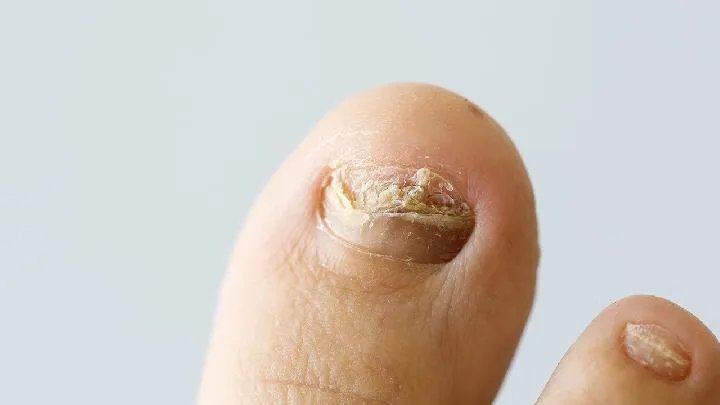 灰指甲的危害是什么？