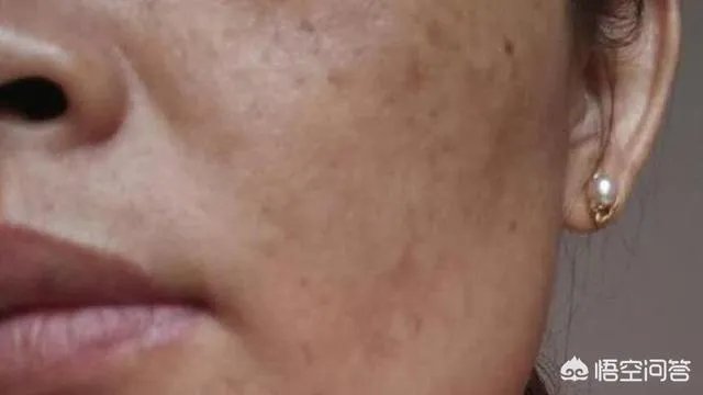 有了黄褐斑，该如何淡化不反弹？