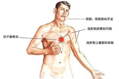 心肌梗塞位置图片