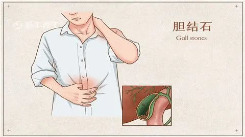 胆囊结石怎么治疗最好的方法