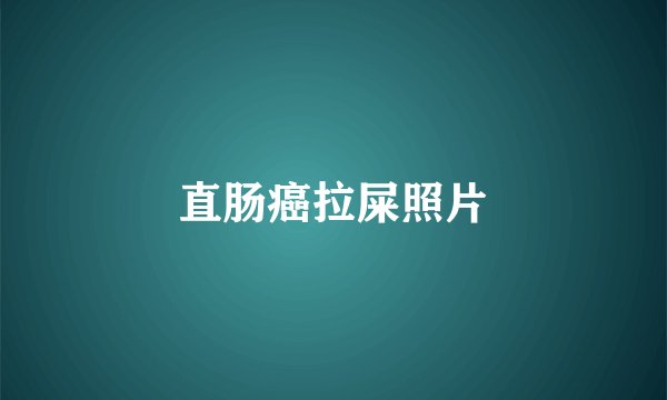 直肠癌拉屎照片
