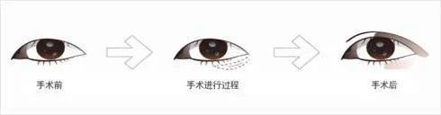 开眼角术前后需要注意的问题有什么?