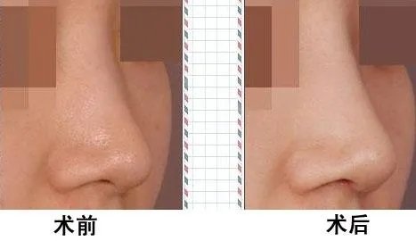 北京玻尿酸隆鼻术多少钱呢