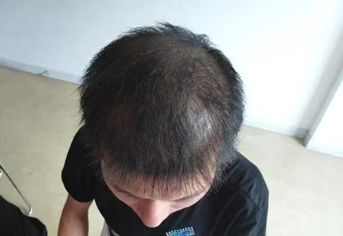 艾福杰尼谢广坤同款秃头笑翻全场,你如何看待年轻人秃头问题?