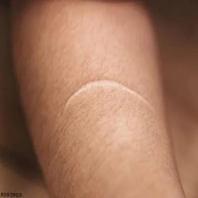 蜂窝织炎怎么根除 了解蜂窝织炎的根除方法