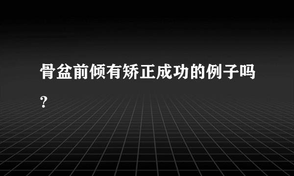 骨盆前倾有矫正成功的例子吗？